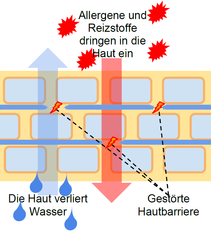 Gestörte Hautbarriere bei Neurodermitis lässt Reizstoffe eindringen