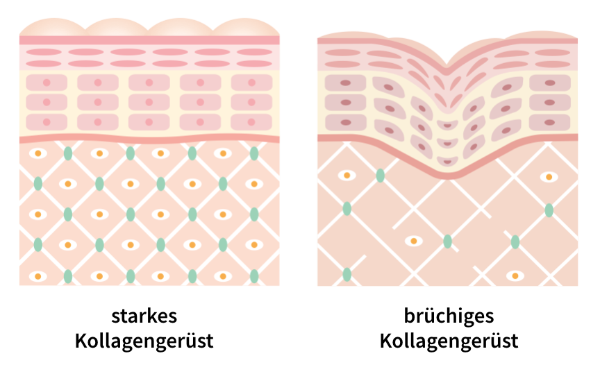 Wie Falten entstehen am Beispiel eines starken und brüchigen Kollagengerüsts